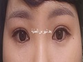 المدير الطبي دو أون روك / جراحة إعادة تجميل الجفن المزدوج بالشق