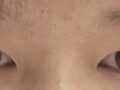 บทวิจารณ์การผ่าตัดแก้ไขเปลือกตาโดยผู้กำกับ โด ออน-ร็อก