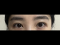 รีวิวการผ่าตัดแก้ไขไหมเย็บที่ฝังอยู่ใต้ผิวหนัง