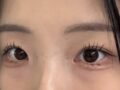 ศัลยกรรมตกแต่งเปลือกตาแบบไม่ต้องกรีด + ยกกระชับเปลือกตาบน