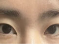 ศัลยกรรมยกเปลือกตาบน + การแก้ไขรอยแผลผ่าตัด