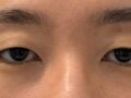 หนึ่งเดือนหลังจากการผ่าตัดทำตาสองชั้นแบบไม่กรีด