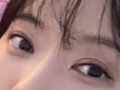 ศัลยกรรมแก้ไขดวงตา การแก้ไขเปลือกตาบน