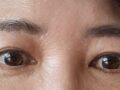 การยกคิ้ว เปลือกตาล่าง