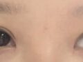 การผ่าตัดเปลือกตาล่างด้านหน้าและด้านหลัง + การผ่าตัดแบบไม่กรีด (การทำตาสองชั้น)