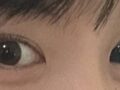 การผ่าตัดเปิดแผล + การแก้ไขเปลือกตา + การปลูกถ่ายไขมัน - ผู้กำกับโด