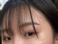 桃園長再手術後期‼️