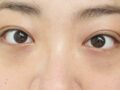 นี่คือบทวิจารณ์เกี่ยวกับการผ่าตัดทำตาสองชั้นแบบใช้เนื้อเยื่อธรรมชาติ!