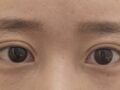 การผ่าตัดแก้ไขสายตาของผู้กำกับโด ออน-รก