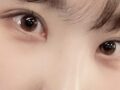 [การผ่าตัดแก้ไข] เย็บปิดแผลซ่อนไหม + ยกเปลือกตาบน, ลาพักงาน 2 เดือน