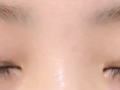 รีวิวการผ่าตัดแก้ไขตาสองชั้น
