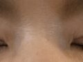 การผ่าตัดแก้ไขตา, การกรีดแผล, การยกเปลือกตาบน