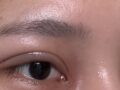 รีวิวการผ่าตัดแก้ไขตาสองชั้น