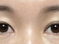 รีวิวการผ่าตัดแก้ไขตาข้างหนึ่ง
