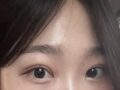 การผ่าตัดแก้ไขสายตาของผู้กำกับโด ออน-รก
