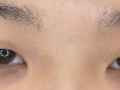 切开 + 提肌矫正 + 上眼角 -> 谢谢都院长 ^^