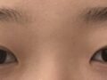 การผ่าตัดแก้ไขการเย็บปิดตาสองชั้น