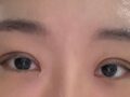 ผู้กำกับ โด ออน-ร็อก - รีวิวการผ่าตัดทำตาสองชั้น Incision