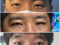 เทคนิคการผ่าตัดแก้ไขหนังตาตก (หนังตาชั้นเดียว) โดยผู้กำกับโด ออน-ร็อก