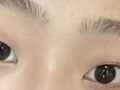 นายแพทย์คิม ฮงจิน ศัลยกรรมตกแต่งเปลือกตาแบบไม่ต้องกรีด