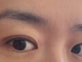 ศัลยกรรมแก้ไขเปลือกตาสองชั้น - คุณหมอโด ออน-รก (2 เดือนต่อมา)