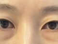 การผ่าตัดทำตาสองชั้นของผู้กำกับโด ออน-รก