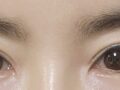 หนึ่งเดือนหลังจากการผ่าตัดแก้ไขสายตาของ ดร.โด ออน-รก