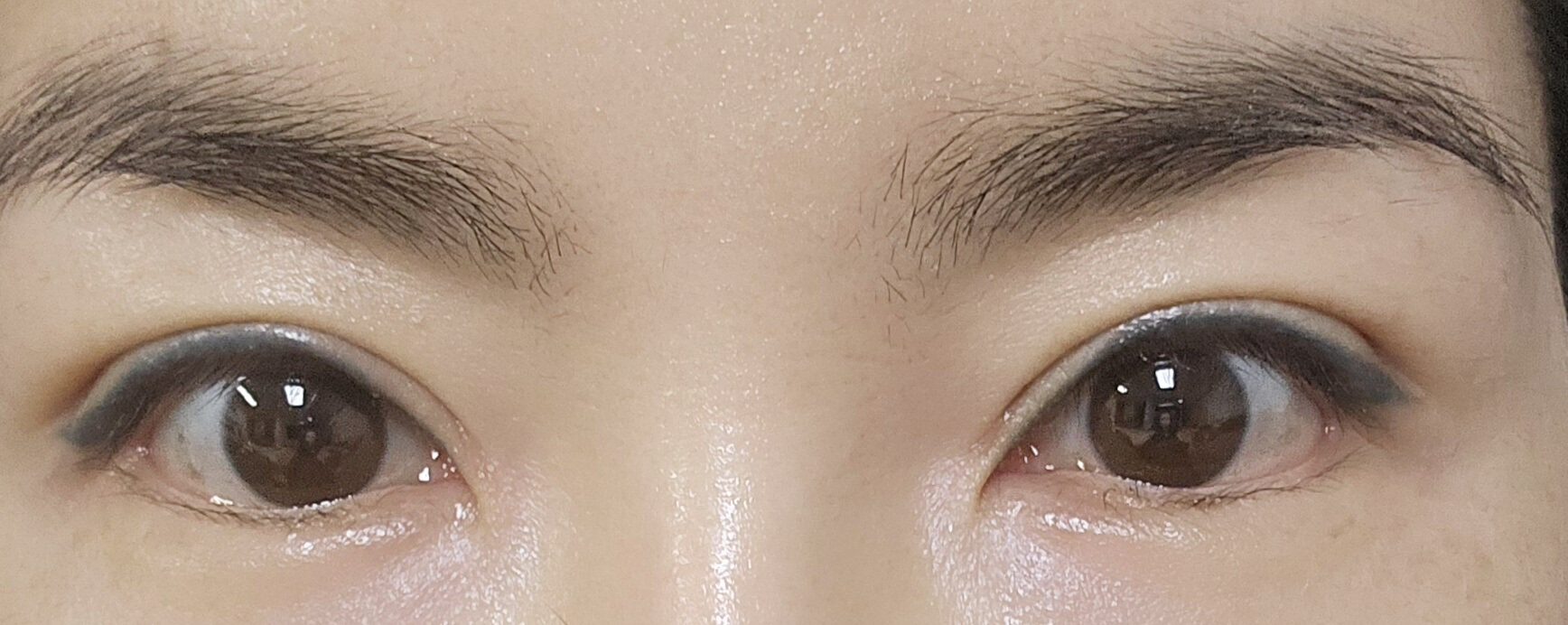หนึ่งเดือนหลังการผ่าตัด