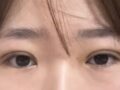 การผ่าตัดแก้ไขสายตาของผู้กำกับโด ออน-รก