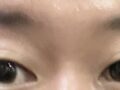 ฉันเข้ารับการผ่าตัดกับผู้กำกับโด ออน-รก เมื่อต้นเดือนกรกฎาคม