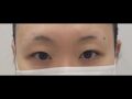 รีวิวการผ่าตัดทำตาสองชั้นของ ดร.โด ออน-ร็อก