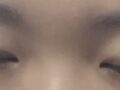 การผ่าตัดตกแต่งเปลือกตาแบบฝังลึก และการยกเปลือกตาบน