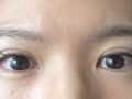 การผ่าตัดแก้ไขสายตาของผู้กำกับโด ออน-รก