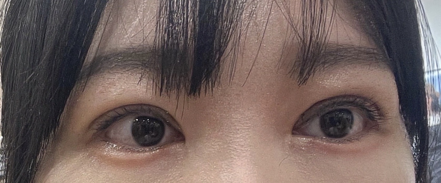 หลังจากผ่าตัดแก้ไขดวงตา! (ฉันผ่าตัดแก้ไขมาแล้ว 3 ครั้ง ดังนั้นเหลือแค่ไหมเย็บด้านขวาในรูปเท่านั้นที่ยังไม่ได้เอาออก!)