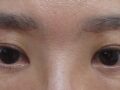 รีวิวการยกกระชับคิ้วของผู้กำกับโด ออน-ร็อก