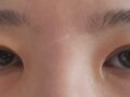 รีวิวการผ่าตัดแก้ไขการยึดเกาะตามธรรมชาติของ ดร. โด ออน-ร็อก