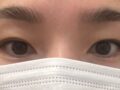自然癒着+ウィットイム（ドアンロック院長）