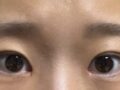 รีวิวการผ่าตัดทำตาสองชั้นแบบไม่กรีด