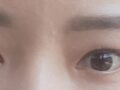 ศัลยกรรมตกแต่งเปลือกตาสองชั้น