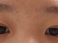 การผ่าตัดตาแบบไม่กรีด