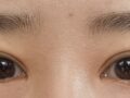 双眼皮修复  术后反馈
