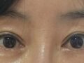 ศัลยกรรมแก้ไขตาสองชั้น