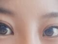 สองเดือนหลังจากการผ่าตัดแก้ไขสายตา