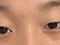 สองเดือนหลังจากการผ่าตัดยกเปลือกตาบนโดยผู้กำกับโด ออน-ร็อก