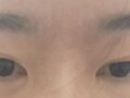 รีวิวการผ่าตัดแก้ไขเปลือกตาโดยผู้กำกับ โด ออน-ร็อก