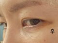 การปรับตำแหน่งใต้ตา