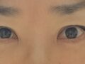 2 เดือนหลังการผ่าตัดตา (ทำตาสองชั้น, ผ่าตัดตกแต่งเปลือกตาล่าง)