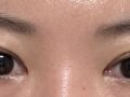 รีวิวการผ่าตัดแก้ไขสายตาของ ดร.โด ออน-รก