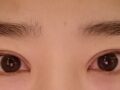 2 เดือนหลังการผ่าตัดแก้ไขแผลผ่าตัด (บุตรชายของผู้กำกับโด ออน-รก)
