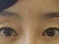 การผ่าตัดแก้ไขที่ประสบความสำเร็จ